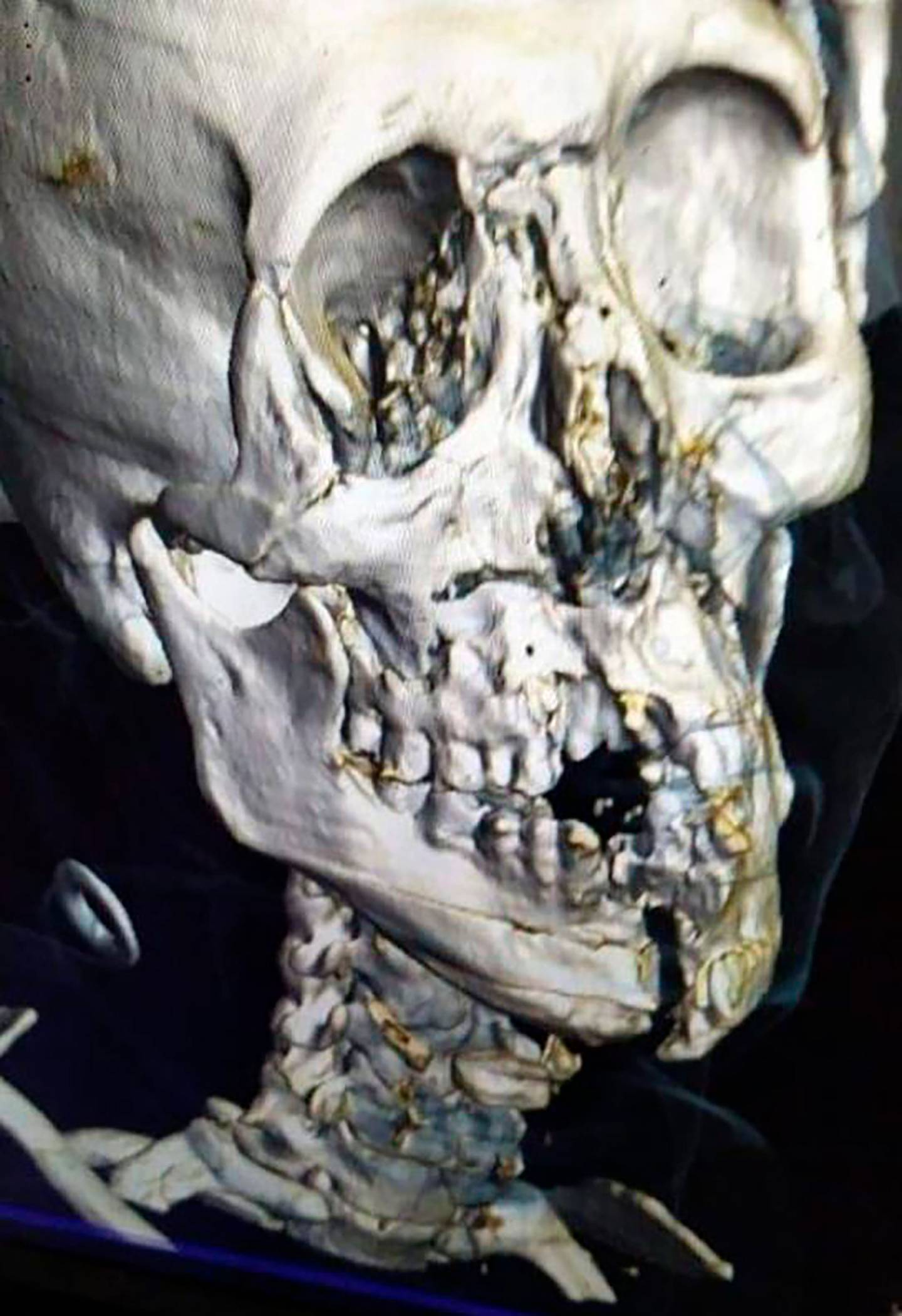 Imagen en 3D de los huesos craneales de Yasser Al-Shahrani