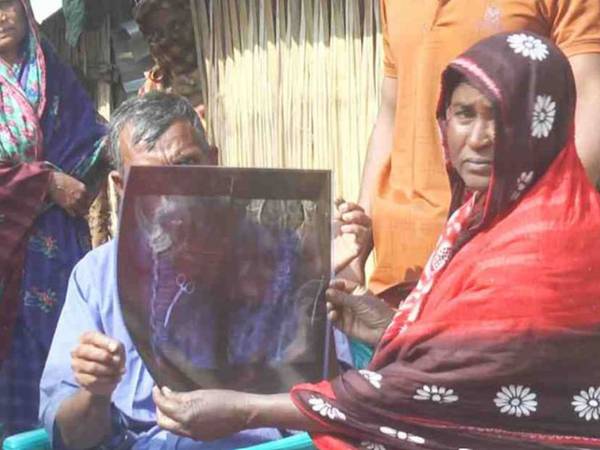 Mujer en Bangladesh vivió 20 años con unas tijeras quirúrgicas en su estómago luego de una cirugía