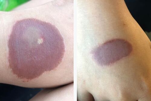 Niña de 10 años deberá hacerse una cirugía tras realizar viral de Tiktok que le quemó sus manos