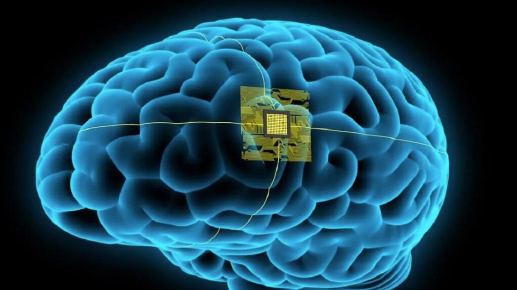 Imagen referencial de un chip en un cerebro.