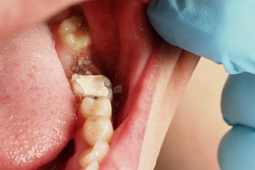 Las enfermedades de los dientes que podrían provocarte un infarto