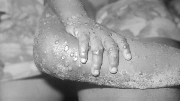 Síntomas de la viruela del mono