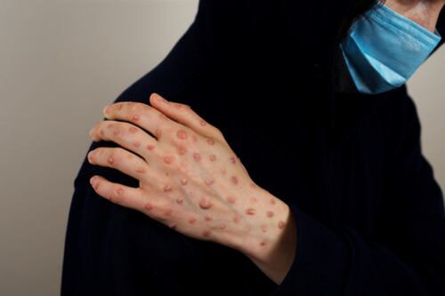 Viruela del mono: estos son los órganos más afectados por la enfermedad