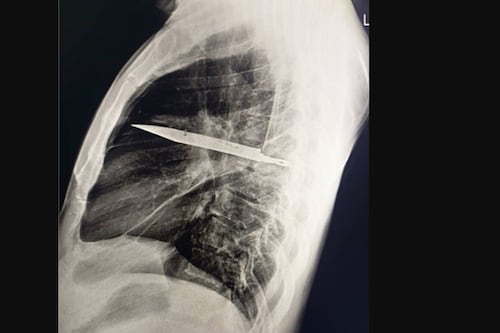 ¿Un cuchillo en el pecho por 8 años? El escalofriante hallazgo médico que desafía las leyes de la biología