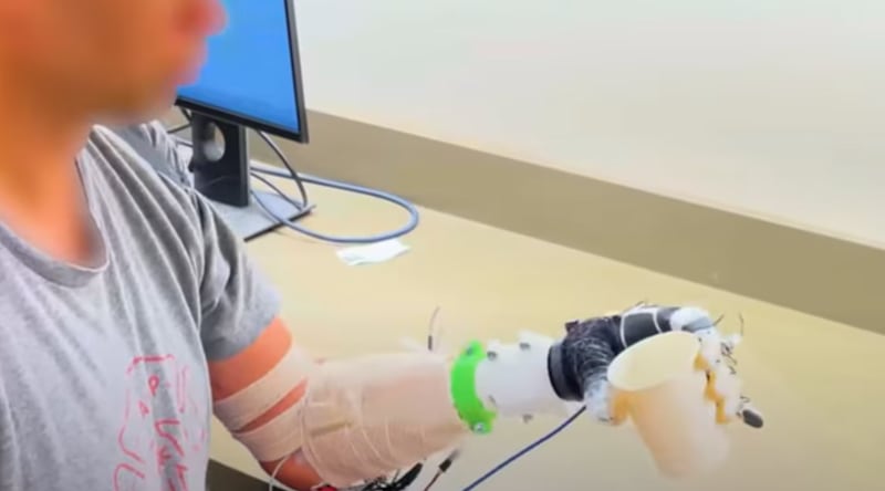 Nueva prótesis con IA