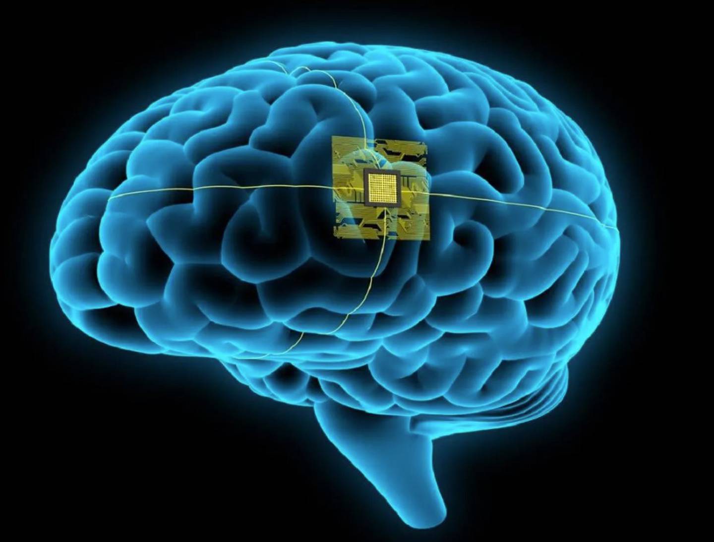 Imagen referencial de un chip en un cerebro.